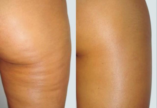 Cellulite